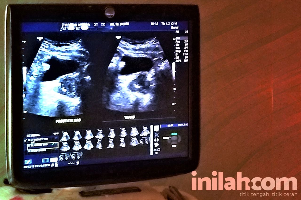 Terbaru Dari Kasus Gagal Ginjal Akut 190 Anak Meninggal Dunia